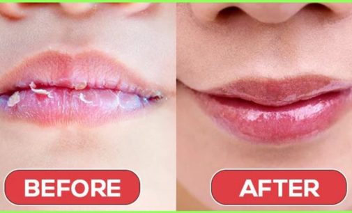 Home remedies for chapped lips