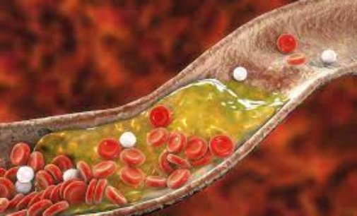 Cholesterol might hold key to new therapies for diabetes, Alzheimer’s disease