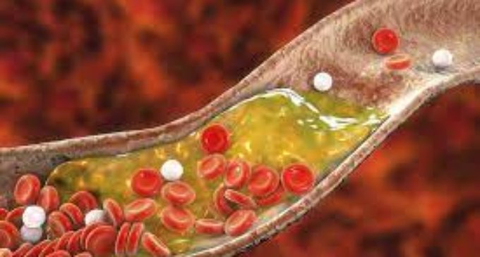 Cholesterol might hold key to new therapies for diabetes, Alzheimer’s disease