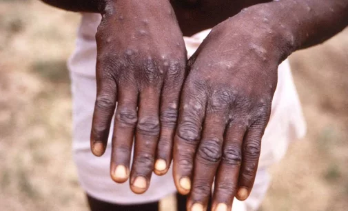 World Health Network declares Monkeypox outbreak a public health emergency