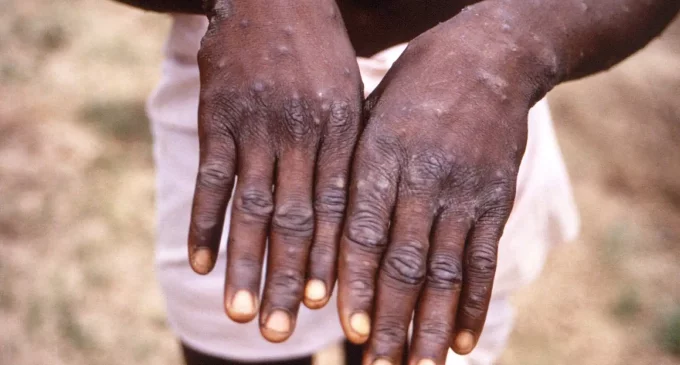 World Health Network declares Monkeypox outbreak a public health emergency